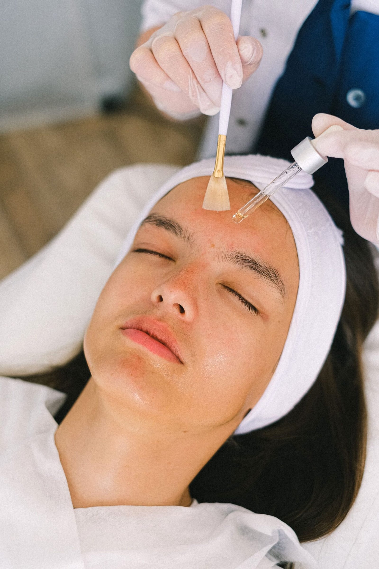Chemical Peel