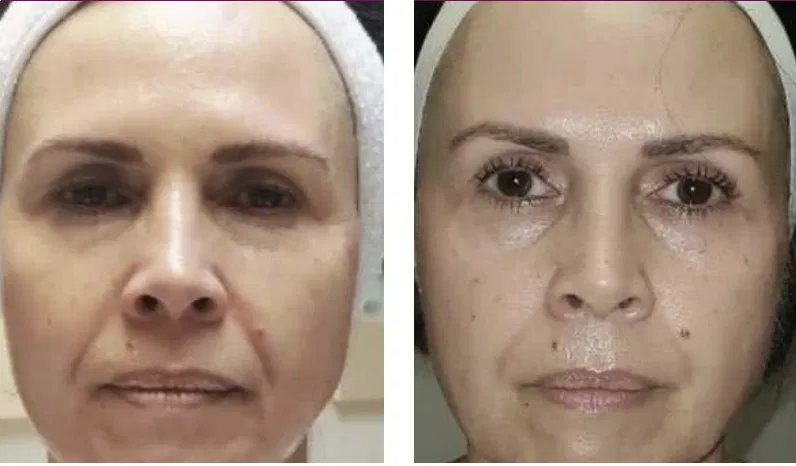 Client full face before and after PRX-T33, showing brighter, firmer-looking skin