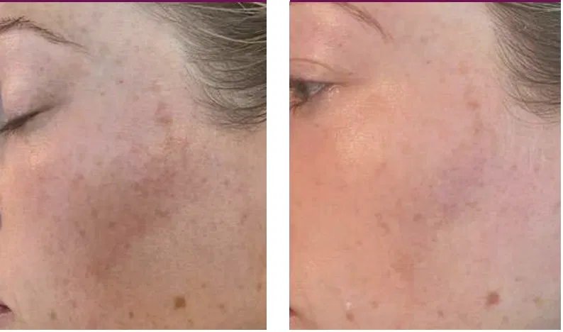 Client cheek before and after PRX-T33, showing reduced pigmentation and more even tone