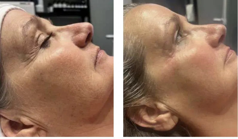 Client profile before and after PRX-T33, showing smoother texture around the eyes and cheek