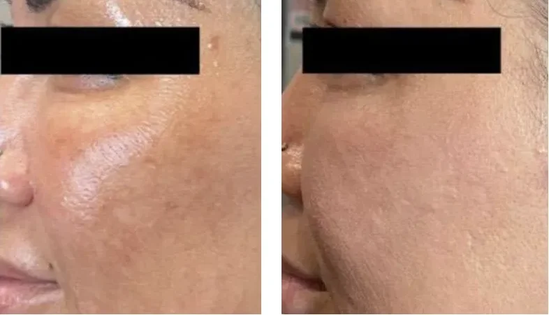 Client cheek and temple before and after PRX-T33, showing faded discoloration